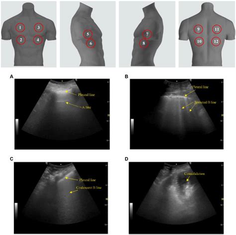 Lung Ultrasound Score Lus The Classic Lus Requires Scanning Zones