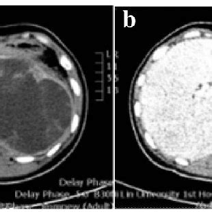 Computed Tomography Ct Scans Showing A Mixed Solid And Cystic Lesion