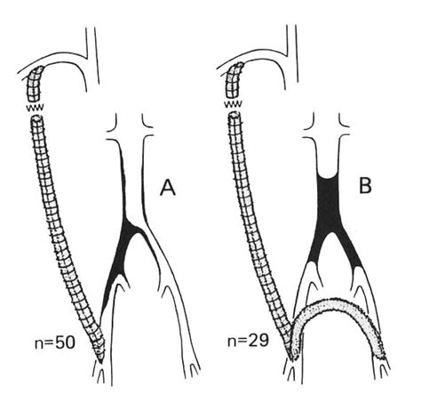 Axillofemoral Bypass With Externally Supported Knitted Dacron Grafts