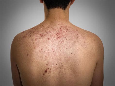 9 Main Causes Of Pimples Acne You Should Know Styles At Life
