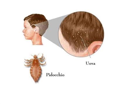 Что такое педикулез у детей с картинками