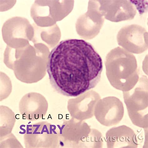 Grupo De Estudos Aplicados à Hematologia Célula De Sézary