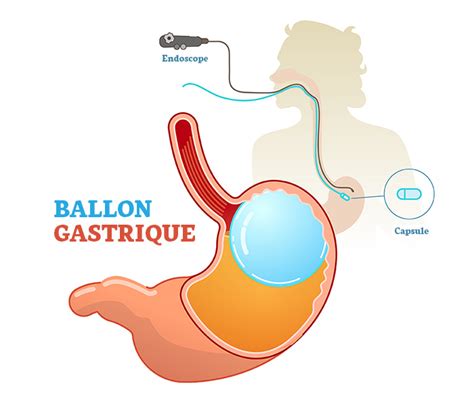 Qu Est Ce Qu Un Ballon Gastrique Op Dr Mehtap Ert Rk