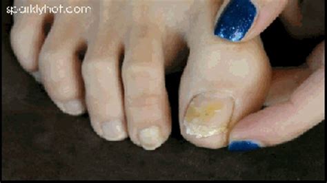 Another Part Of My Fungus Nail Fall Off Hd Mp Sparklyhots Hot Clips Clips Sale