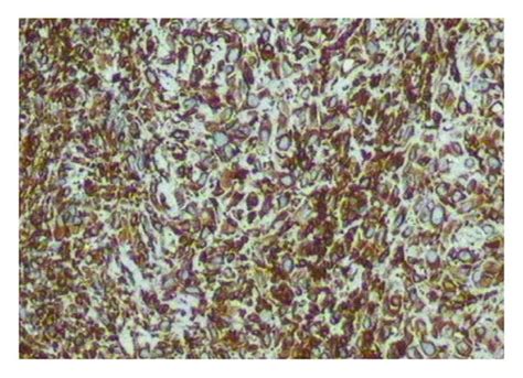 Abdominal Ct And Cytohistological Features On Hande Stained Specimens Or Download Scientific