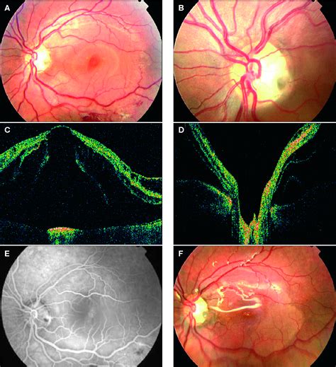 Figure 1 From Vitrectomy And Silicone Oil Tamponade For Serous Macular