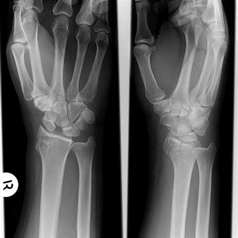 Scapholunate Dissociation Image Radiopaedia Org