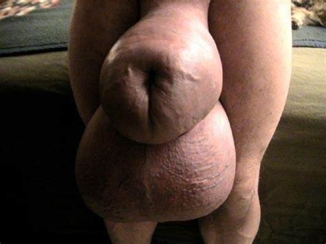 Scrotal Edema Pics Hot Sex Picture