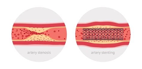 Types of stents in angioplasty, Recovery Time, Post surgery & more