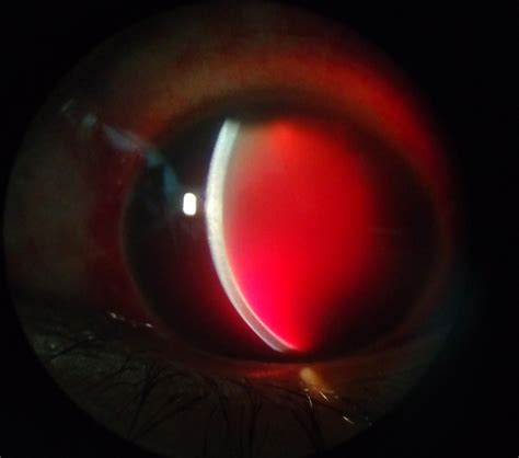 is hyphema in cats painful