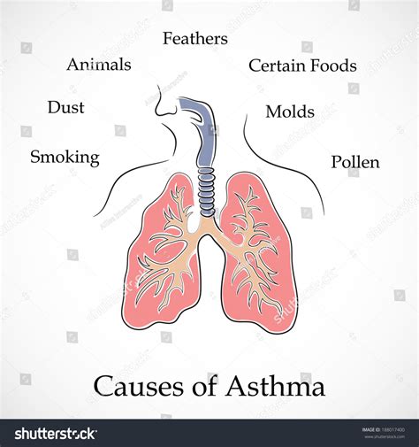 Illustration Human Lungs Causes Asthma On Vetor Stock Livre De