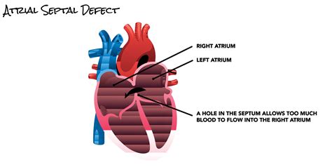 Septum Heart