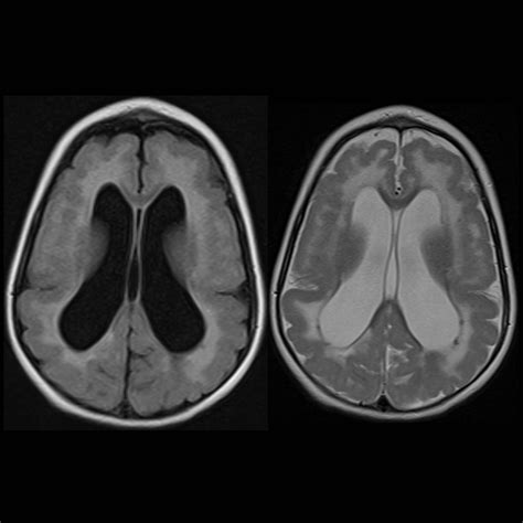 Pediatric Cytomegalovirus Encephalitis | Pediatric Radiology Reference ...