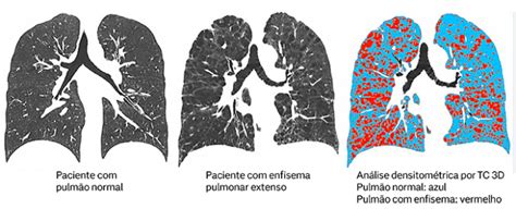 O Que Causa Mancha No Pulmão - Enfisema pulmonar: o que é, sintomas, causas e tratamento | Nav Dasa