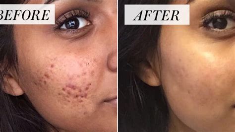 Controversial Cystic Acne Routine Goes Viral — Before-and-After Photos | Allure