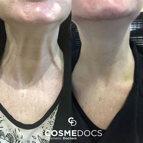 Botox In Neck Is A Fantastic Treatment For Nefertiti Neck Lift Cosmedocs