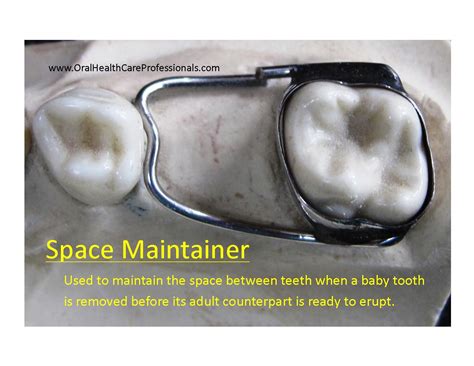 teeth spacer removal  cynthia cannon blog