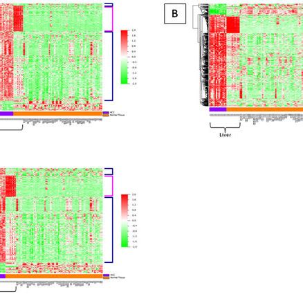 Heat Maps Of Tumor Specific Genes Identified In HCC A HBV Related