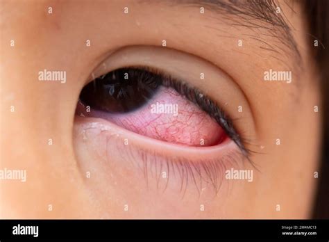 Macro Of A Very Red Eye With Oriental Features Due To Conjunctivitis