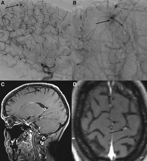Hereditary Hemorrhagic Telangiectasia Brain