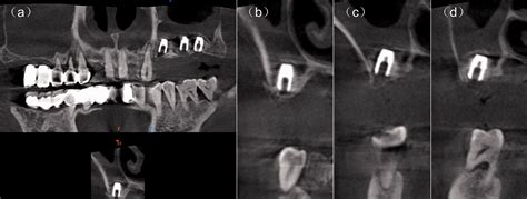 Displacement Of The Full Body Of A Dental Implant Into The Sinus Space