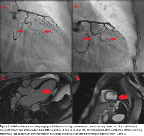 Double Trouble Recurrent Spontaneous Coronary Artery Dissection In A