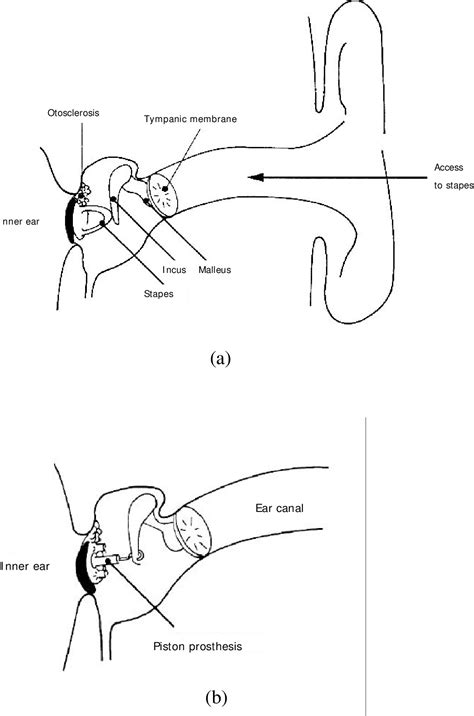 Figure 1 from Estimation of the stapes-bone thickness in the ...