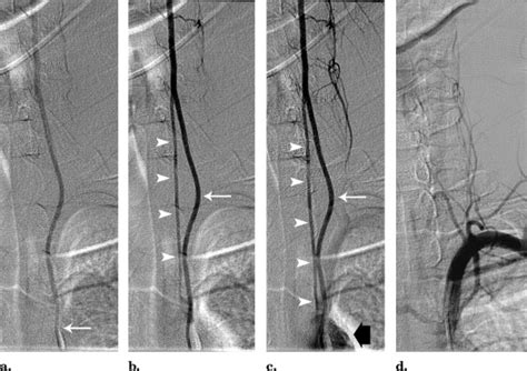 Bifid Direct Aortic Arch Origin Of Left Vertebral Artery A Unique