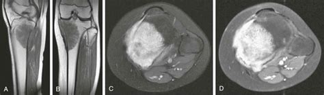 Staging Bone and Soft Tissue Tumors - Clinical Tree