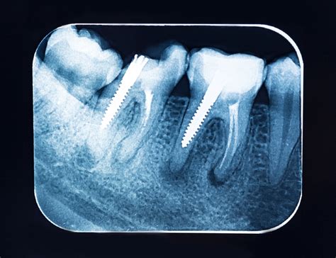 Dent Sur Pivot Quelle Est La Différence Avec L Implant