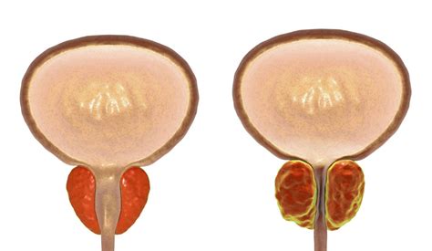 An enlarged prostate gland and incontinence - Harvard Health