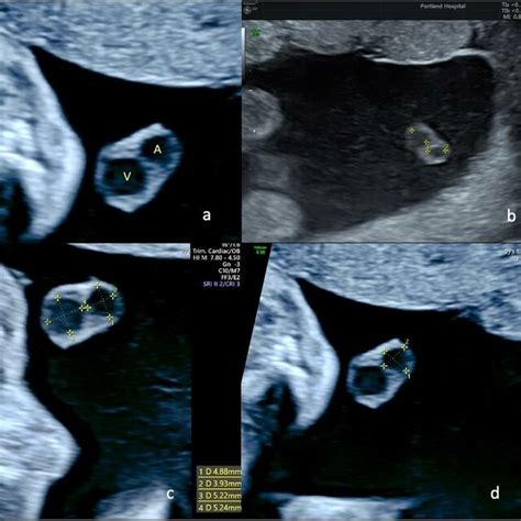 Ultrasound Views Of The Umbilical Cord And Its Insertion At The Level Download Scientific