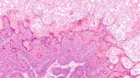 Microscopic Image Of A Proliferating Epidermoid Cyst A Type Of