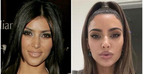 Kim Kardashian Before And After: Plastic Surgery Timeline