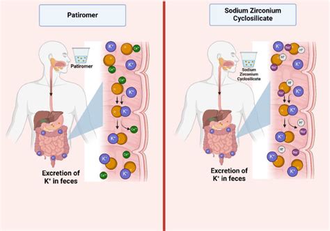 strategies   treatment  hyperkalemia european journal