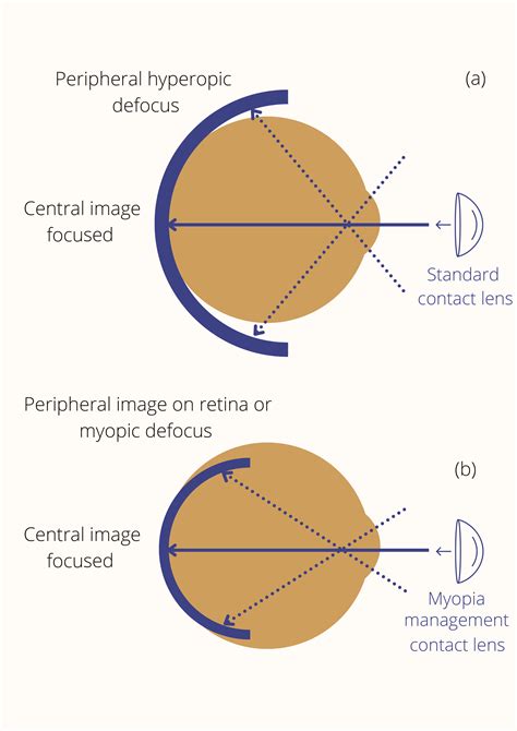 Optician Online CPD Archive