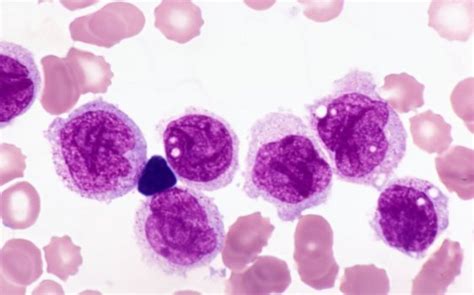 Acute monocytic leukemia | Pathology Student