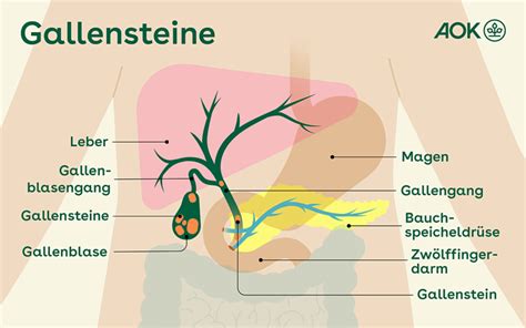 Gallensteine Ursache Symptome Und Behandlung