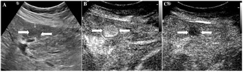 It Illustrates An Example Of Misinterpretation With Li Rads Ceus