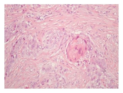 He 200x Invasive High Grade Carcinoma With Squamous Differentiation