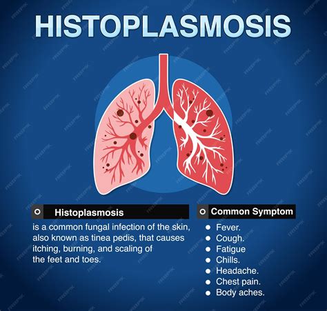 Premium Vector | Informative poster of histoplasmosis