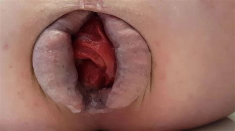 My Asscunt Puffy Lips To Small Prolapse Gay Anal Porn XHamster