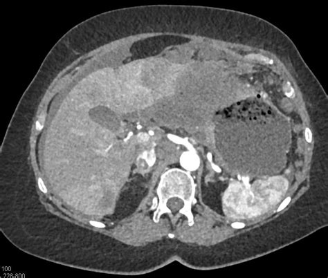 Gastric Adenocarcinoma With Liver Metastases And Carcinomatosis Liver