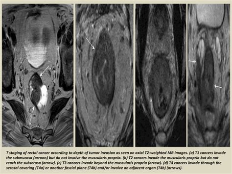 Presentation Radiological Imaging Of Anal Carcinoma PPTX
