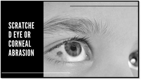 Eye Injury: Signs, Symptoms, Types, and Prevention tips