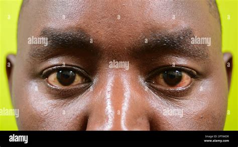 Red Eye Clos Up With Conjunctivitis Black Man Red Eye Stock Photo Alamy