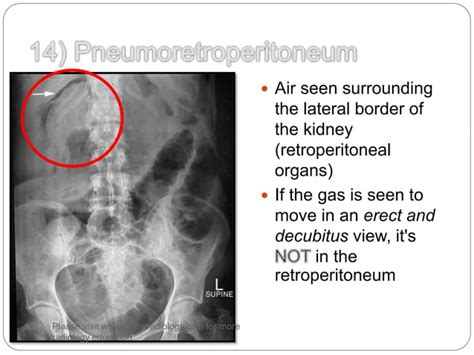 Signs In Pneumoperitoneum Ppt