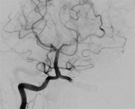 vertebral artery dissection managed  interventional radiology bmj
