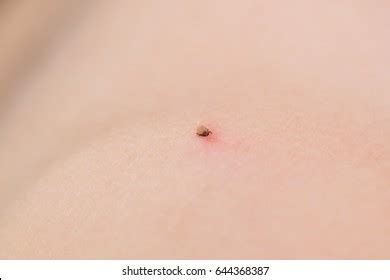 Deer Tick Embedded In Skin By Science Stock Photography