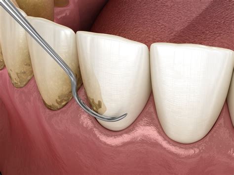 The Scaling And Root Planing Procedure — Charlotte Dental Esthetics